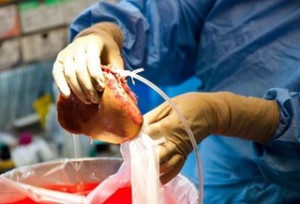Organ donation